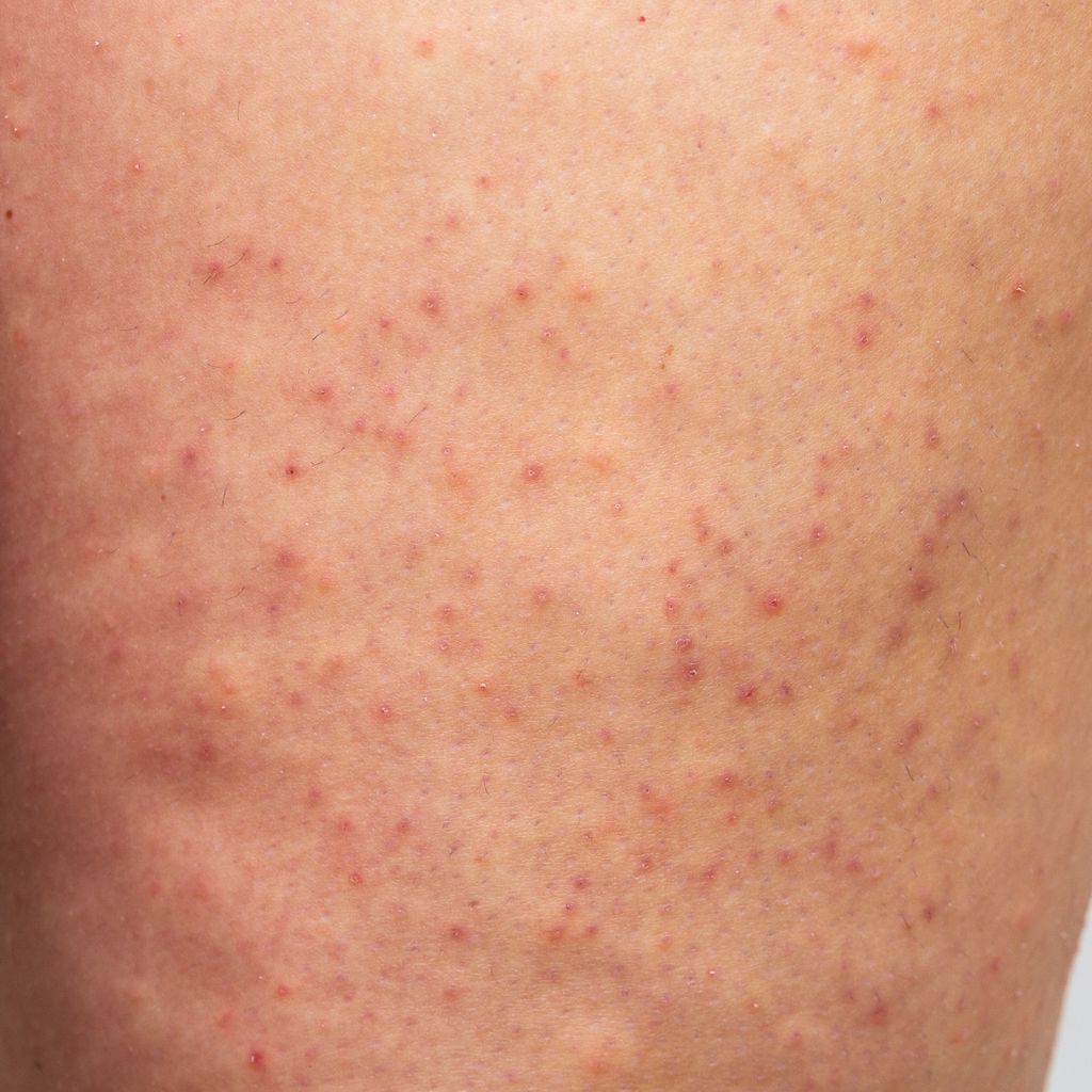The Power of a Shower Filter: How SOMA Helped Me Finally Reduce My Keratosis Pilaris